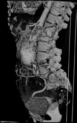 Abdominal Aortic Aneurysm (AAA) - CTisus CT Scan