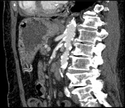 Superior Mesenteric Artery (SMA) Stenosis - CTisus CT Scan