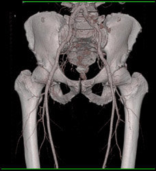 Normal Femoral Artery - CTisus CT Scan