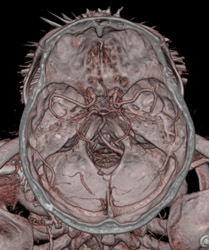 Normal Circle of Willis - CTisus CT Scan