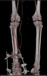 CTA - Leg S/P Trauma - CTisus CT Scan