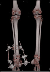 Normal Runoff Vessels - CTisus CT Scan