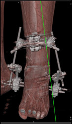 Vary the Opacity in VRT - CTisus CT Scan