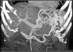 Splenic Vein Occlusion - CTisus CT Scan