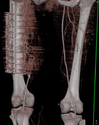 Small Collaterals to Popliteal Artery - CTisus CT Scan