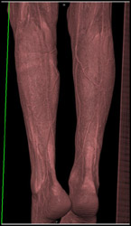 Tibial Fracture With Soft Tissue - CTisus CT Scan