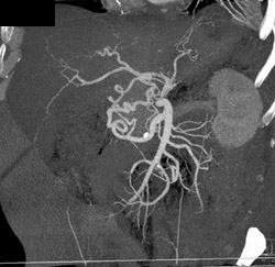 Median Arcuate Ligament Syndrome - CTisus CT Scan