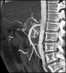 Median Arcuate Ligament Syndrome - CTisus CT Scan