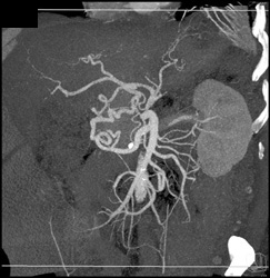 Median Arcuate Ligament Syndrome With Collaterals - CTisus CT Scan