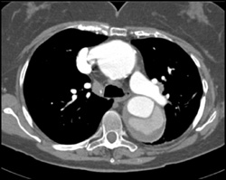 Aortic Dissection - CTisus CT Scan