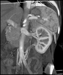 Circumaortic Renal Vein - CTisus CT Scan