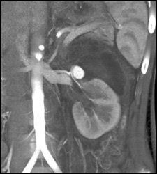 Renal Artery Pseudoaneurysm S/P Trauma - CTisus CT Scan