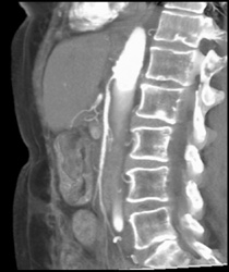 Superior Mesenteric Artery (SMA) Stenosis - CTisus CT Scan