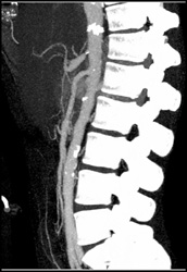 Celiac and Superior Mesenteric Artery (SMA) Stenosis - CTisus CT Scan