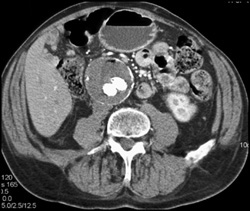 Post Endostent Repair - CTisus CT Scan