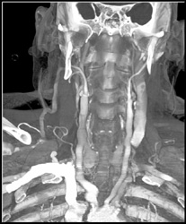 Diseased Carotid Artery - CTisus CT Scan