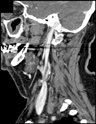 Carotid Artery Plaque - CTisus CT Scan