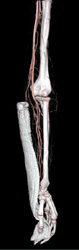 Abscess in Forearm - CTisus CT Scan