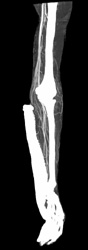 CTA Arm - CTisus CT Scan