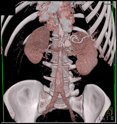 Splenic Artery Aneurysm - CTisus CT Scan