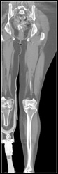 Patent Aortoiliac Stent - CTisus CT Scan