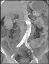 Normal Graft - CTisus CT Scan