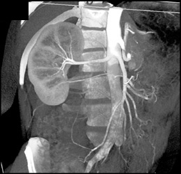 2 Right Renal Arteries - CTisus CT Scan