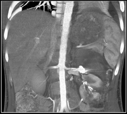 Embolized Left Renal Artery Aneurysm - CTisus CT Scan