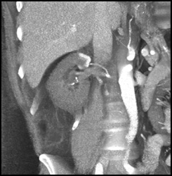 Infarcted Kidney With Flow to Upper Pole From Accessory Artery - CTisus CT Scan