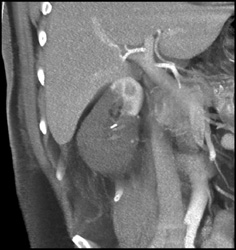 Infarcted Kidney - CTisus CT Scan