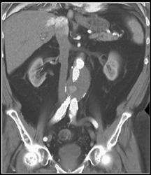 Abdominal Aortic Aneurysm (AAA) Repair With Endoleak - CTisus CT Scan