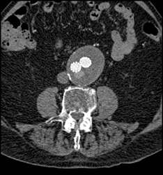 Endoleak - CTisus CT Scan