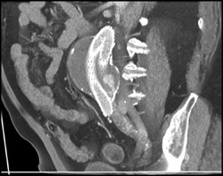 Endoleak - CTisus CT Scan