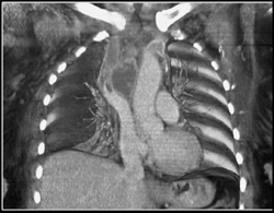 Innominate Vein and SVC Clot - CTisus CT Scan