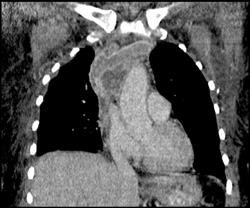 Clot Extends Into SVC - CTisus CT Scan