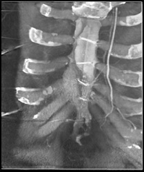 Right Internal Mammary Artery Used for Grafts - CTisus CT Scan