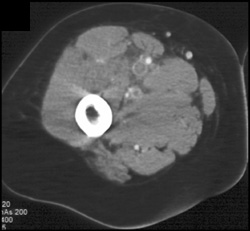 Deep Vein Thrombosis (DVT) - CTisus CT Scan