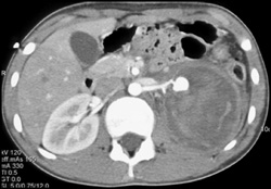 Renal Artery Pseudoaneurysm - CTisus CT Scan