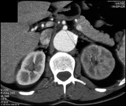 Aortic Dissection With Decreased Flow From Left Kidney - CTisus CT Scan