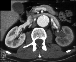 Decreased Function in Left Kidney - CTisus CT Scan