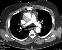 Type A Dissection - CTisus CT Scan