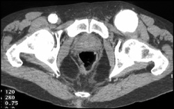 Femoral Artery Aneurysm - CTisus CT Scan