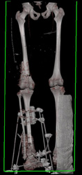 CTA in Patient With Open Reduction Internal Fixation (ORIF) - CTisus CT Scan