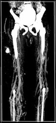 Klippel-Trenaunay-Weber (KTW) Syndrome With Venous Aneurysm - CTisus CT Scan