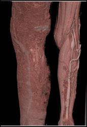 Venous Aneurysms in Patient With Klippel-Trenaunay-Weber (KTW) Syndrome - CTisus CT Scan