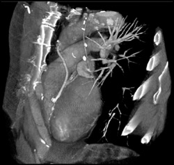 Normal Coronary Artery Aneurysms - CTisus CT Scan