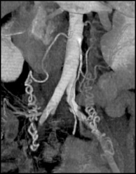 Patent Ovarian Arteries - CTisus CT Scan