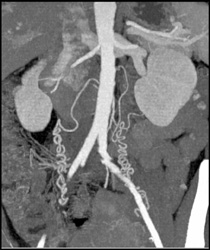 Ovarian Arteries - CTisus CT Scan