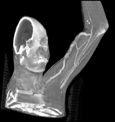 Av Graft - CTisus CT Scan