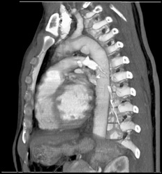 Traumatic Pseudoaneurysms - CTisus CT Scan